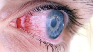 neotlozhnye dejjstviya, kogda cheshutsya glaza pri allergii, i kompleksnoe lechenie pri silnojj allergicheskojj reakcii8 Невідкладні дії, коли сверблять очі при алергії, та комплексне лікування при сильної алергічної реакції