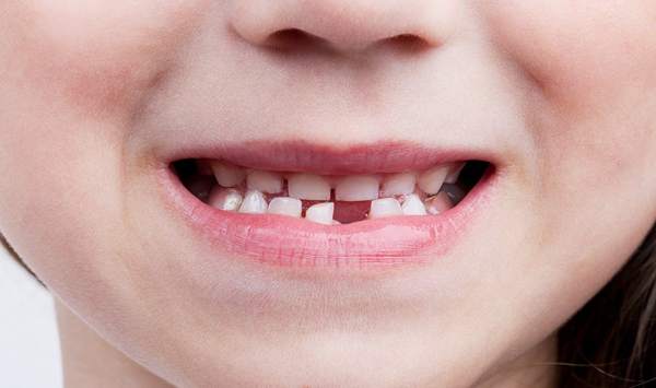 9b3b5d60fb8c209847270b0a24f6d162 Що робити з першим випало молочним зубом у дитини – прикмети розкажуть можна зберігати його і куди подіти