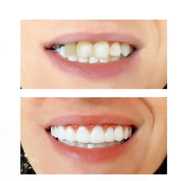 kak nadevat viniry dlya zubov perfect smile veneers 111 Як надягати вініри для зубів Perfect Smile Veneers?