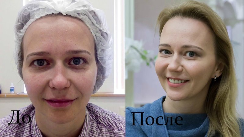 otzyvy pro proceduru ultraformer lifting dlya lica88 Відгуки про процедуру ультраформер ліфтинг для обличчя