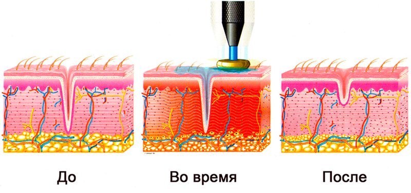 rf lifting dlya lica   vse nyuansy procedury i realnaya polza337 RF ліфтинг для обличчя — всі нюанси процедури і реальна користь