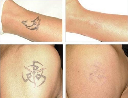 0e3155297d612945d5931caa60c4ddbd Як вивести татуювання лазером, рецепти в домашніх умовах без шрамів. Фото до і після