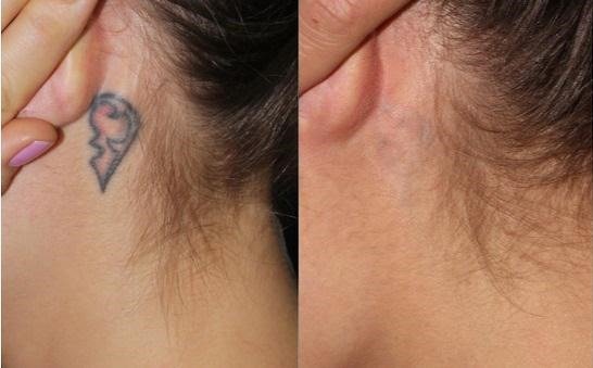2391a6177a6c1072f56fc4ebfd9bcd2b Як вивести татуювання лазером, рецепти в домашніх умовах без шрамів. Фото до і після