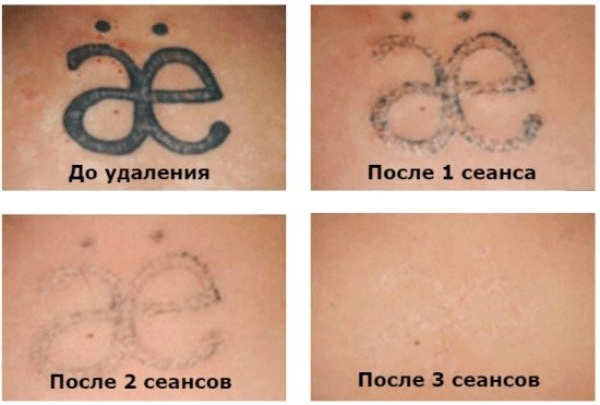 9977b1d3992ad97a84e080611e3a5944 Як вивести татуювання лазером, рецепти в домашніх умовах без шрамів. Фото до і після