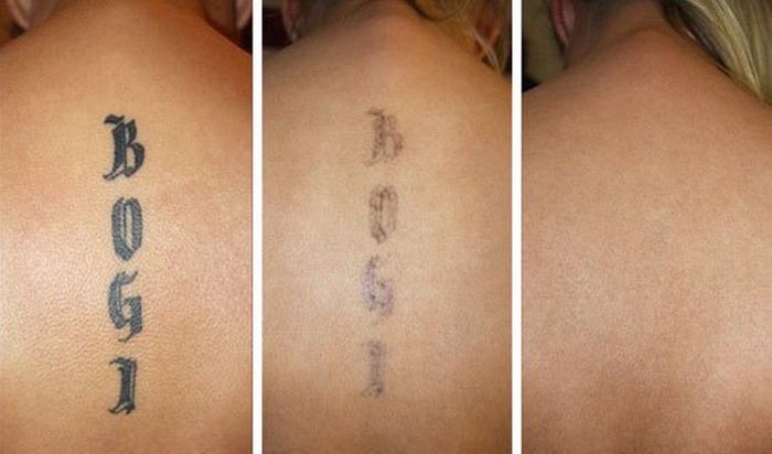 ac41da60e317b164600865b9db59c03c Як вивести татуювання лазером, рецепти в домашніх умовах без шрамів. Фото до і після