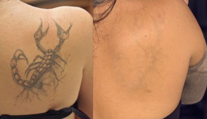 b9223d6dd68ee8f9e80d1b1732abc696 Як вивести татуювання лазером, рецепти в домашніх умовах без шрамів. Фото до і після