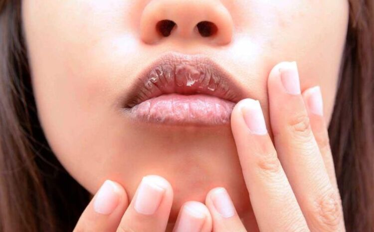 80287e0c7a49c4de8369d3c7e961e223 Тріщини на губах — причини і лікування в домашніх умовах