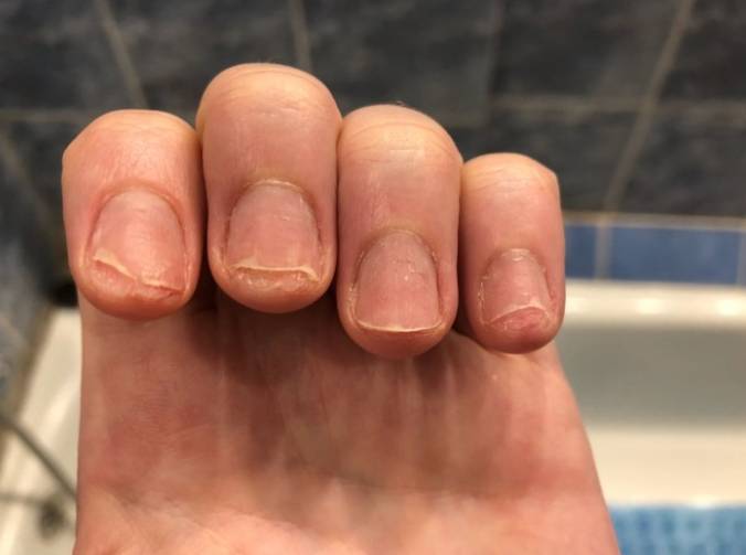 8f185120948066031c5a8aa92f267ce3 Оніхолізисом нігтів на руках: причини і лікування після гель лаку
