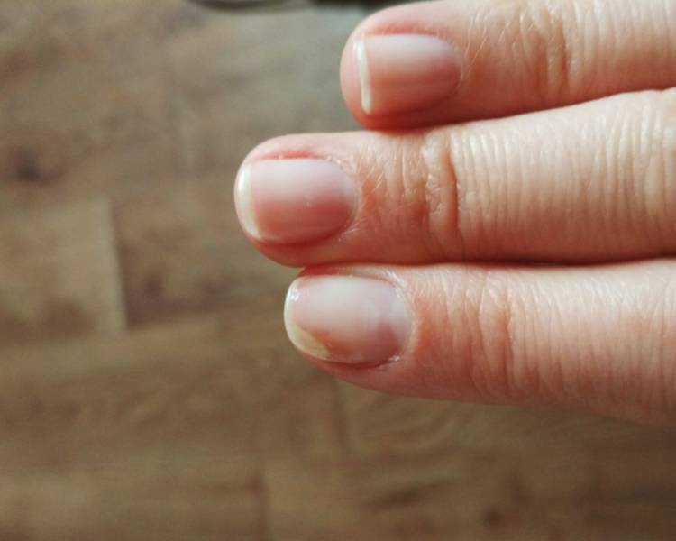 af186409b69e83184c6cf656a1c95553 Оніхолізисом нігтів на руках: причини і лікування після гель лаку