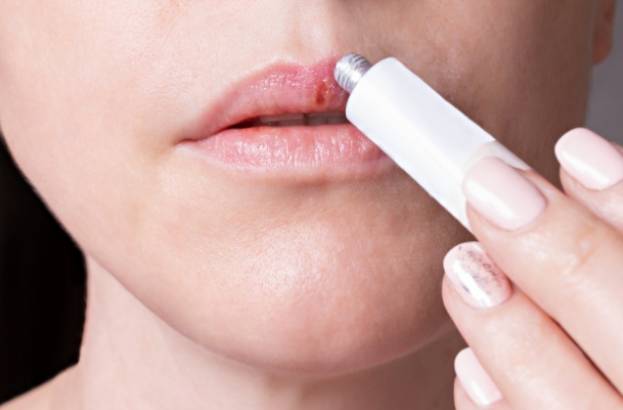 bcf4747159019e3a367948b8a716b656 Тріщини на губах — причини і лікування в домашніх умовах