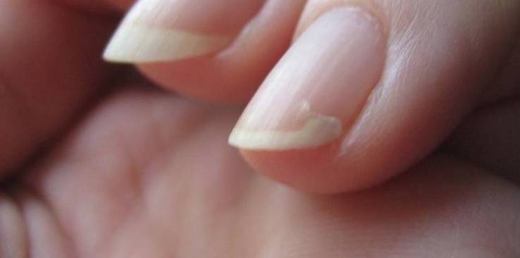 c56271d777f9f829f61708014c42a1fc Оніхолізисом нігтів на руках: причини і лікування після гель лаку