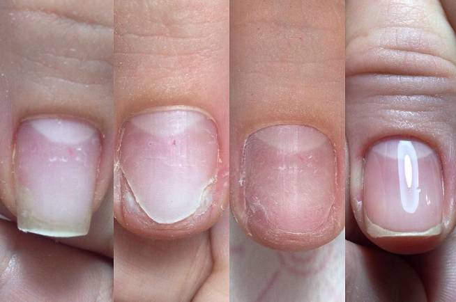 f0e3becc75a2f718d622542498f69ac0 Оніхолізисом нігтів на руках: причини і лікування після гель лаку